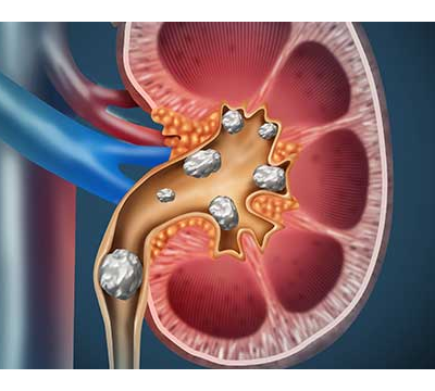 Kidney Stone Specialist in Meerut